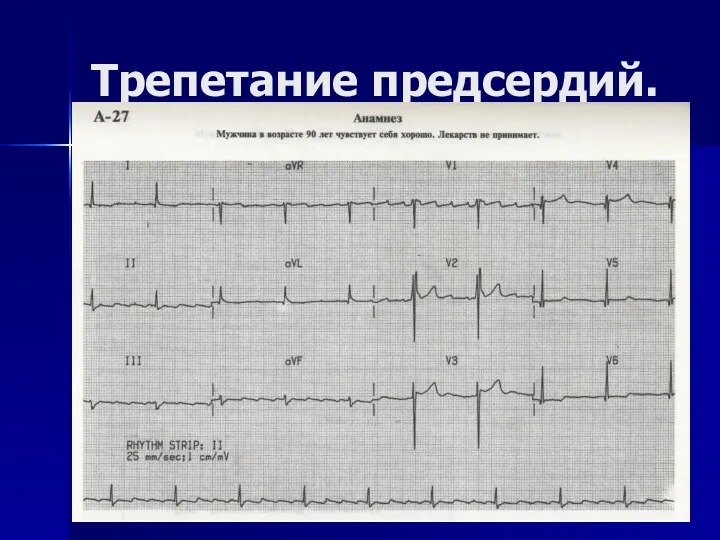 Трепетание предсердий.