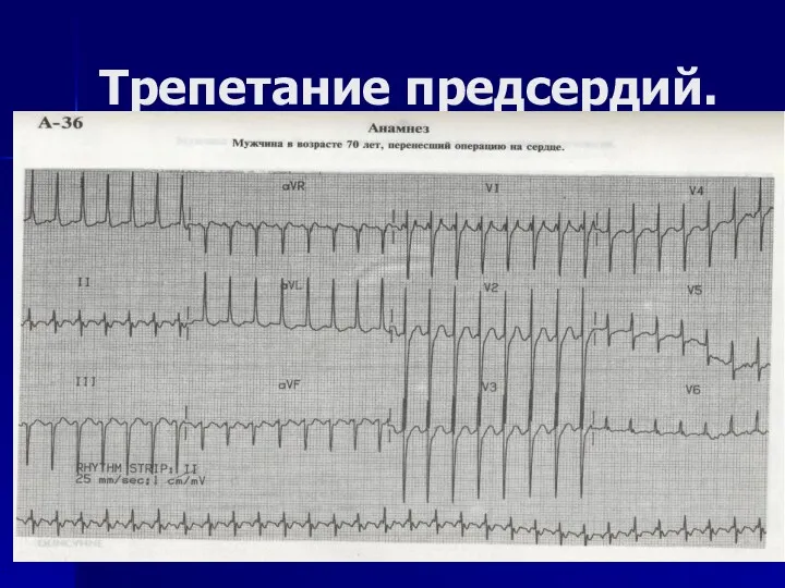 Трепетание предсердий.