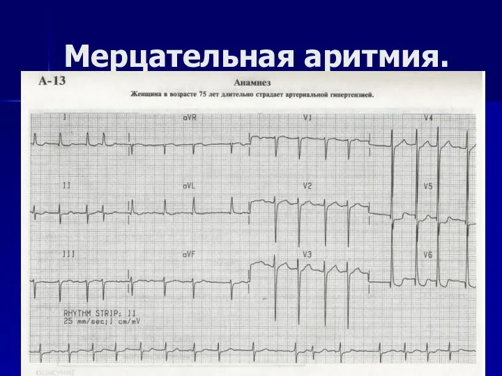 Мерцательная аритмия.