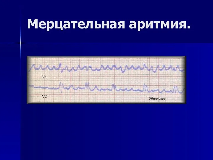 Мерцательная аритмия.