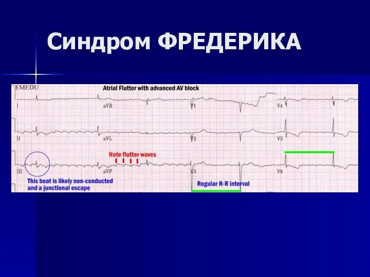 Синдром ФРЕДЕРИКА