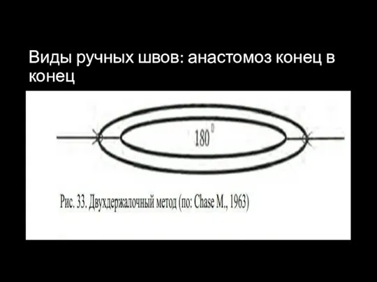 Виды ручных швов: анастомоз конец в конец