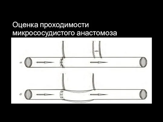 Оценка проходимости микрососудистого анастомоза