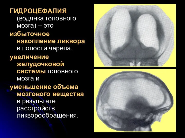 ГИДРОЦЕФАЛИЯ (водянка головного мозга) – это избыточное накопление ликвора в