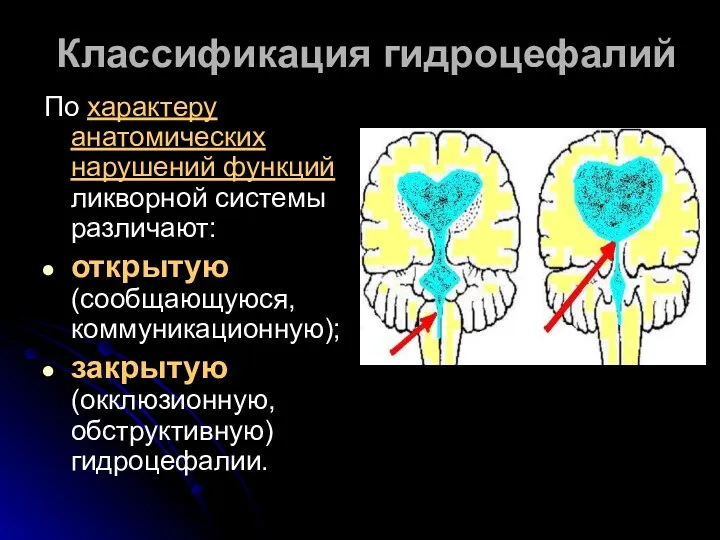 Классификация гидроцефалий По характеру анатомических нарушений функций ликворной системы различают: