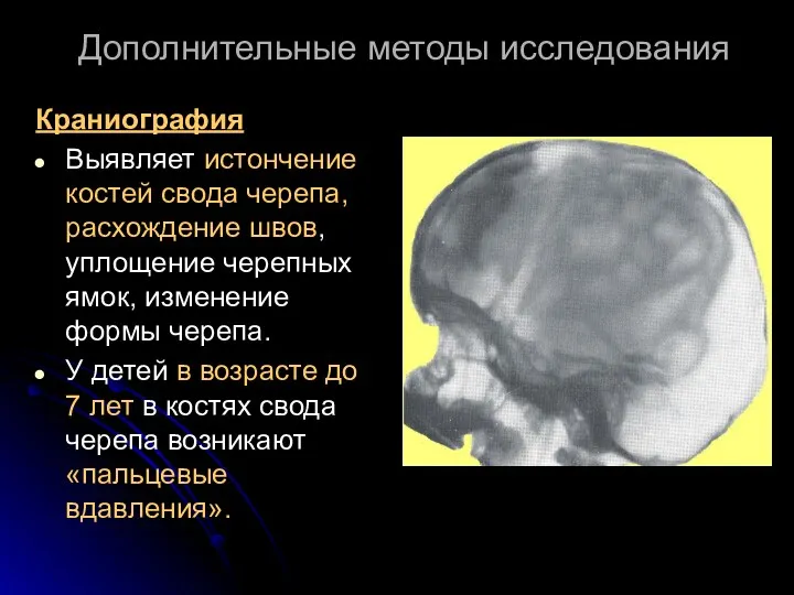 Краниография Выявляет истончение костей свода черепа, расхождение швов, уплощение черепных