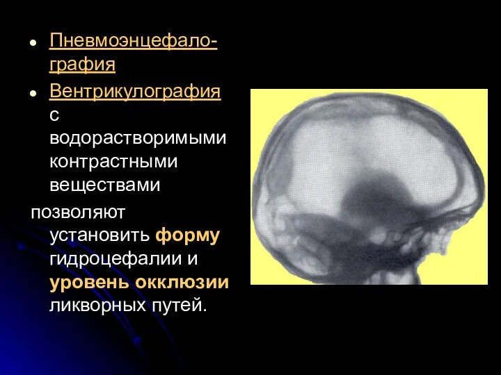 Пневмоэнцефало-графия Вентрикулография с водорастворимыми контрастными веществами позволяют установить форму гидроцефалии и уровень окклюзии ликворных путей.