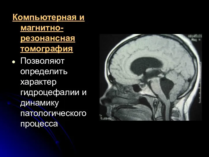 Компьютерная и магнитно-резонансная томография Позволяют определить характер гидроцефалии и динамику патологического процесса