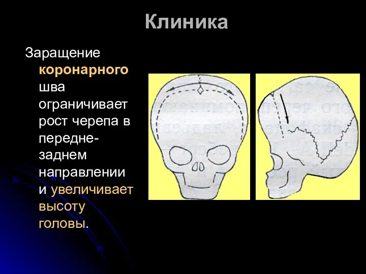 Клиника Заращение коронарного шва ограничивает рост черепа в передне-заднем направлении и увеличивает высоту головы.