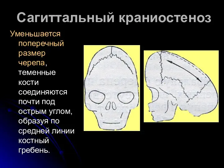 Сагиттальный краниостеноз Уменьшается поперечный размер черепа, теменные кости соединяются почти