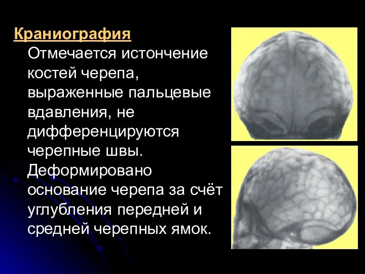 Краниография Отмечается истончение костей черепа, выраженные пальцевые вдавления, не дифференцируются