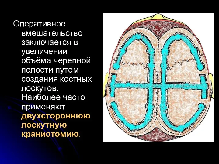 Оперативное вмешательство заключается в увеличении объёма черепной полости путём создания