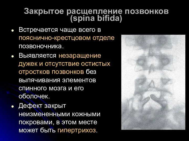 Встречается чаще всего в пояснично-крестцовом отделе позвоночника. Выявляется незаращение дужек