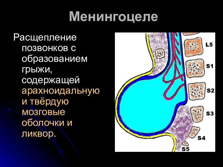 Менингоцеле Расщепление позвонков с образованием грыжи, содержащей арахноидальную и твёрдую мозговые оболочки и ликвор.