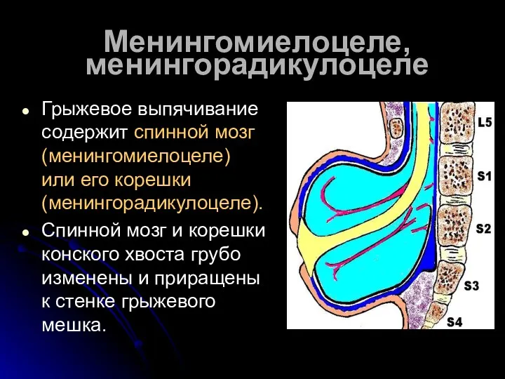 Менингомиелоцеле, менингорадикулоцеле Грыжевое выпячивание содержит спинной мозг (менингомиелоцеле) или его