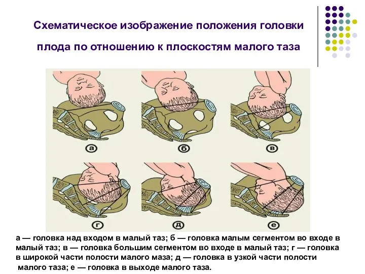 Схематическое изображение положения головки плода по отношению к плоскостям малого