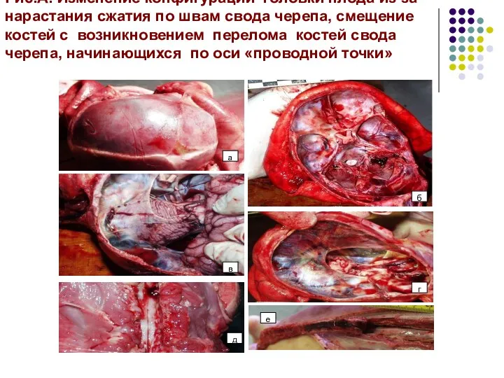 Рис.А. Изменение конфигурации головки плода из-за нарастания сжатия по швам