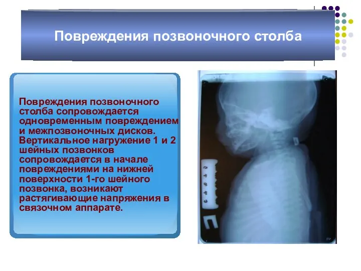 Повреждения позвоночного столба Повреждения позвоночного столба сопровождается одновременным повреждением и