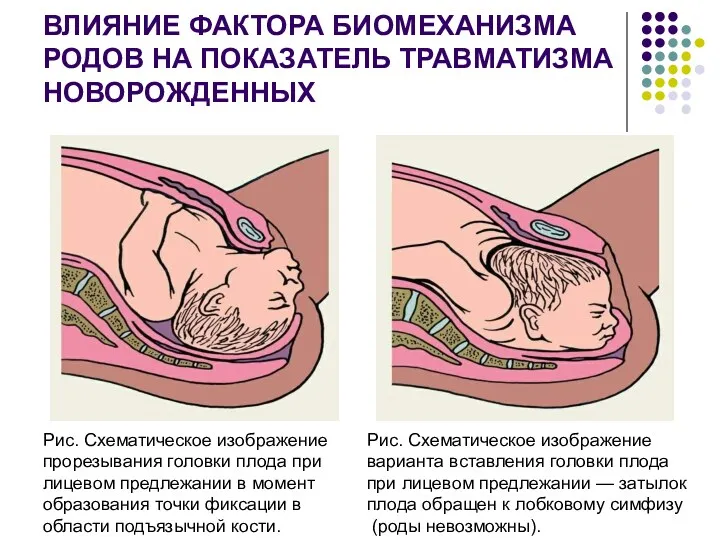 ВЛИЯНИЕ ФАКТОРА БИОМЕХАНИЗМА РОДОВ НА ПОКАЗАТЕЛЬ ТРАВМАТИЗМА НОВОРОЖДЕННЫХ Рис. Схематическое