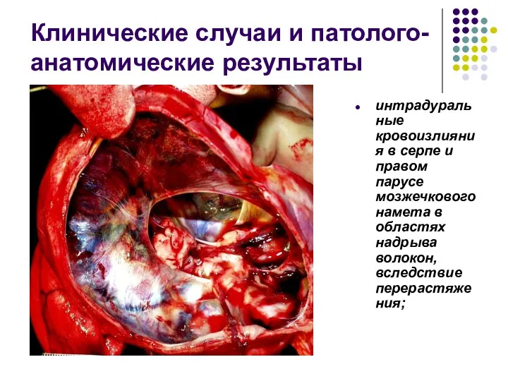 Клинические случаи и патолого-анатомические результаты интрадуральные кровоизлияния в серпе и