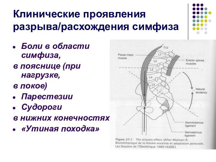 Клинические проявления разрыва/расхождения симфиза Боли в области симфиза, в пояснице