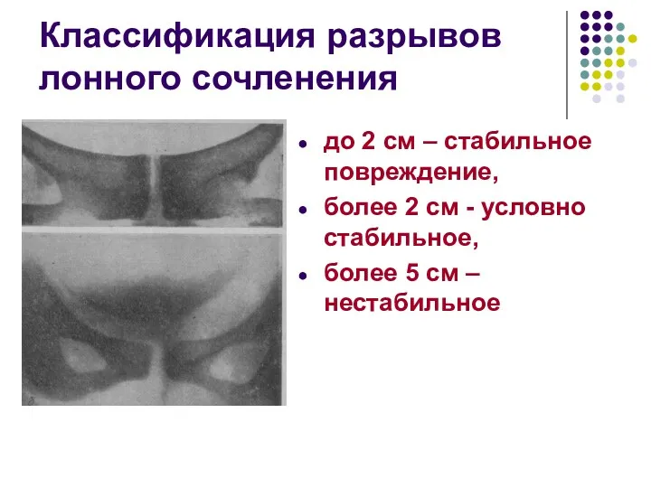 Классификация разрывов лонного сочленения до 2 см – стабильное повреждение,