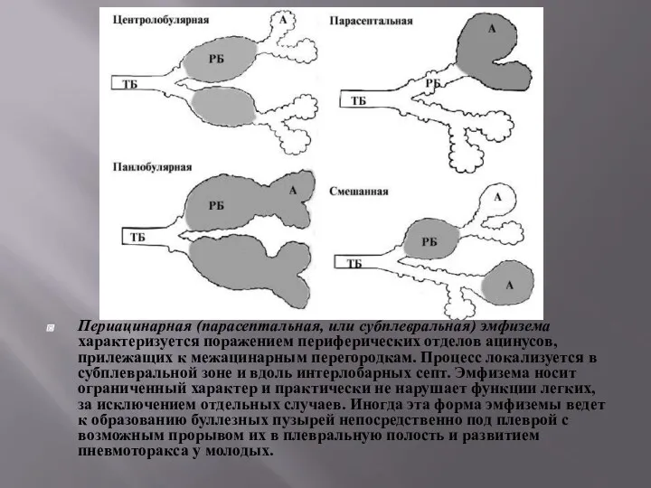 Периацинарная (парасептальная, или субплевральная) эмфи­зема характеризуется поражением периферических отделов ацинусов, прилежащих к межацинарным