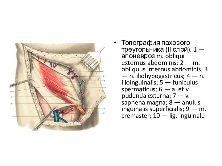 Топография пахового треугольника (II слой). 1 — апоневроз m. obliqui