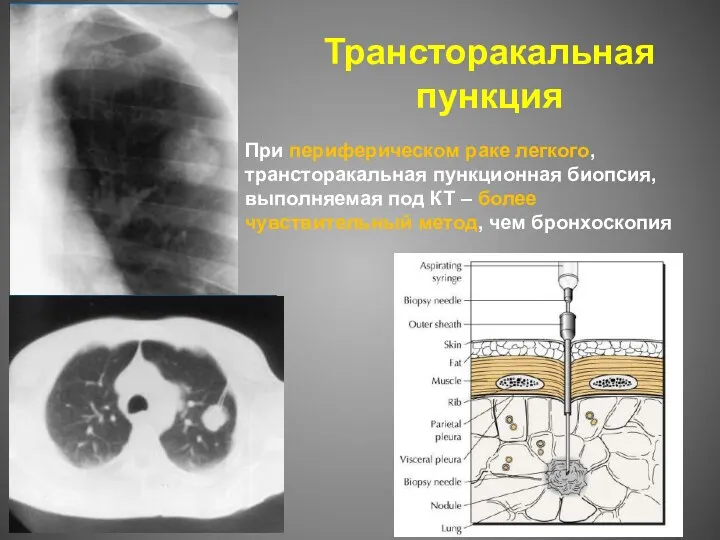 Трансторакальная пункция При периферическом раке легкого, трансторакальная пункционная биопсия, выполняемая