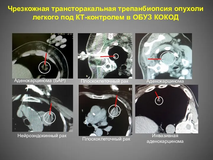 Чрезкожная трансторакальная трепанбиопсия опухоли легкого под КТ-контролем в ОБУЗ КОКОД