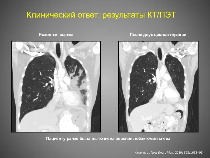 Исходная оценка После двух циклов терапии Пациенту ранее была выполнена