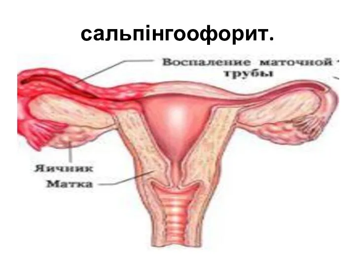 сальпінгоофорит.