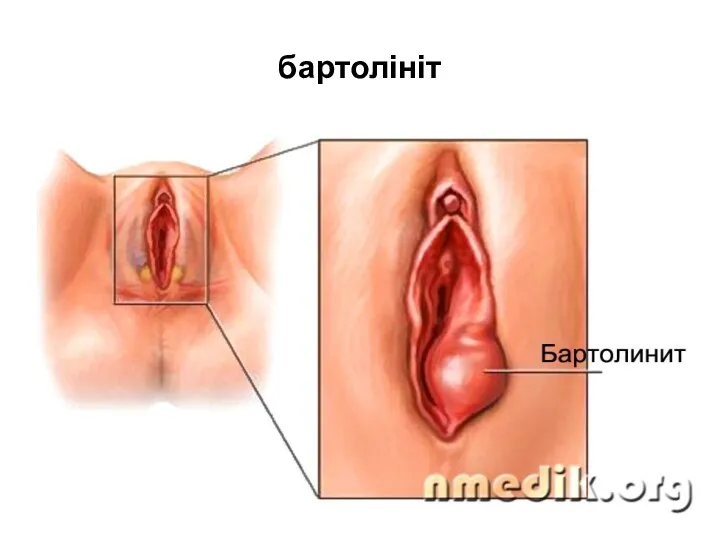 бартолініт