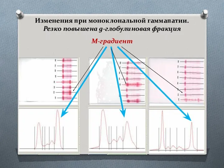 Изменения при моноклональной гаммапатии. Резко повышена g-глобулиновая фракция М-градиент