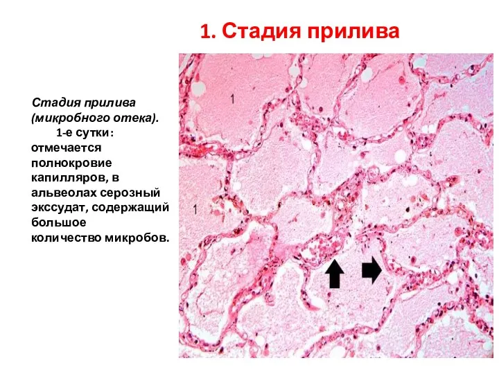 Стадия прилива (микробного отека). 1-е сутки: отмечается полнокровие капилляров, в