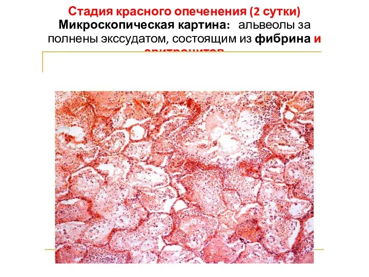 Стадия красного опеченения (2 сутки) Микроскопическая картина: альвеолы за­ полнены экссудатом, состоящим из фибрина и эритроцитов