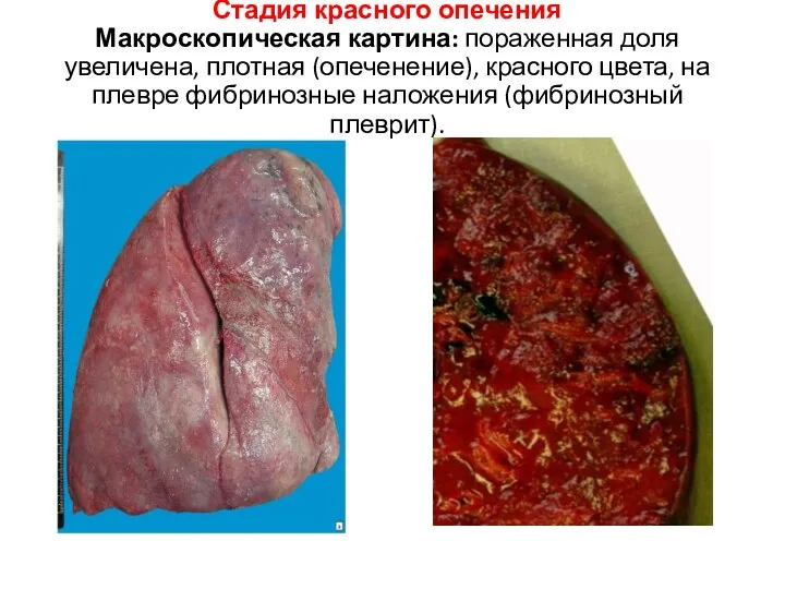 Стадия красного опечения Макроскопическая картина: пораженная доля увеличена, плотная (опеченение),