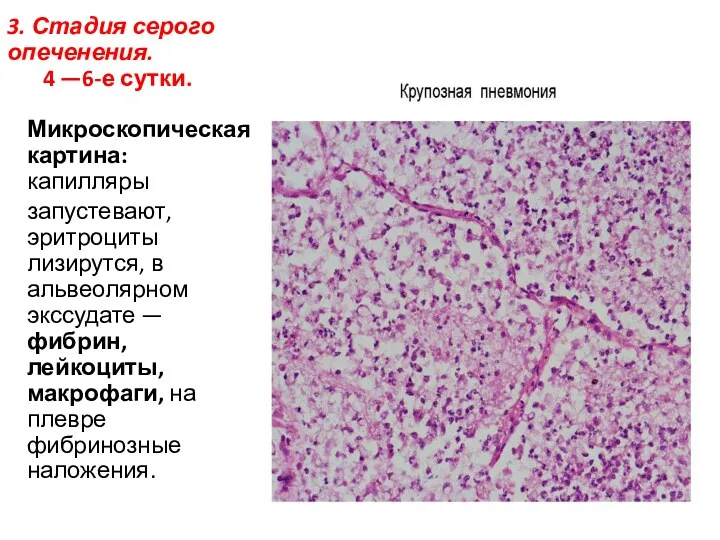 3. Стадия серого опеченения. 4 —6-е сутки. Микроскопическая картина: капилляры