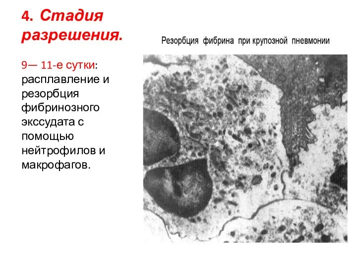 4. Стадия разрешения. 9— 11-е сутки: расплавление и резорбция фибринозного экссудата с помощью нейтрофилов и макрофагов.