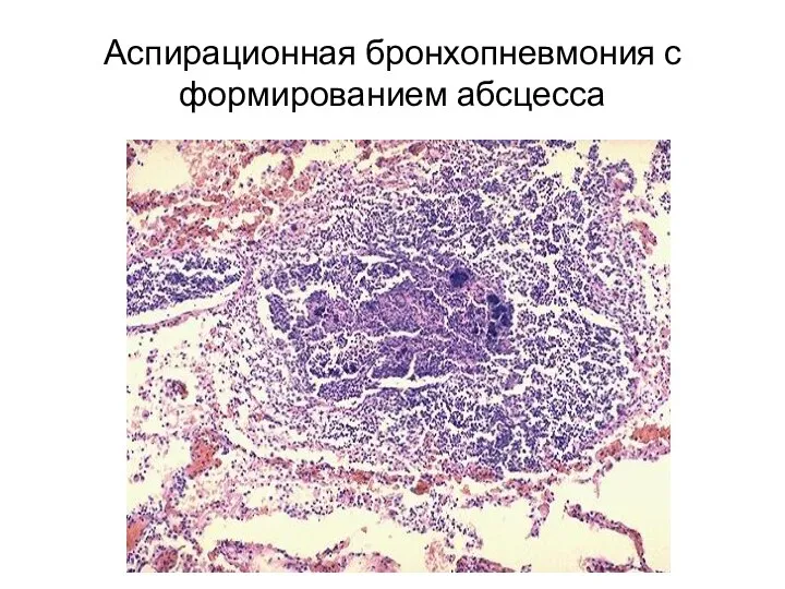 Аспирационная бронхопневмония с формированием абсцесса