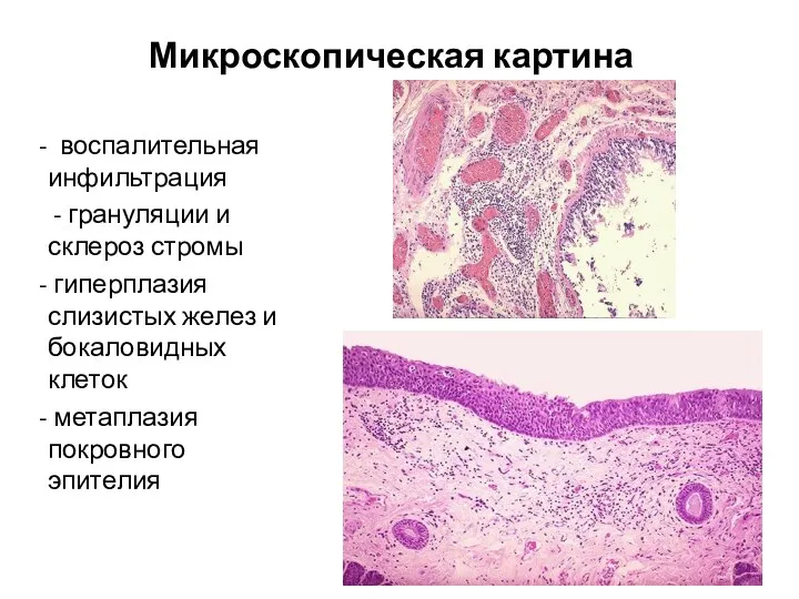 Микроскопическая картина воспалительная инфильтрация - грануляции и склероз стромы гиперплазия