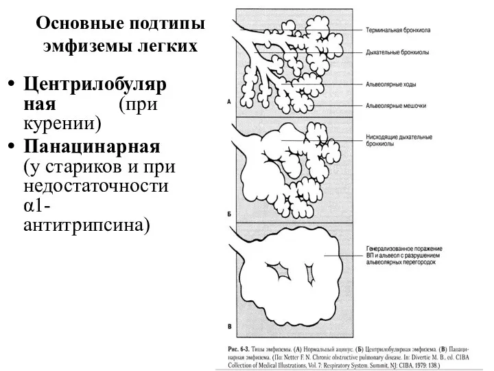 Основные подтипы эмфиземы легких Центрилобулярная (при курении) Панацинарная (у стариков и при недостаточности α1-антитрипсина)