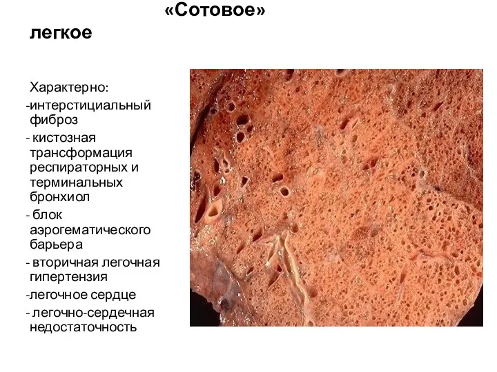 «Сотовое» легкое Характерно: интерстициальный фиброз кистозная трансформация респираторных и терминальных