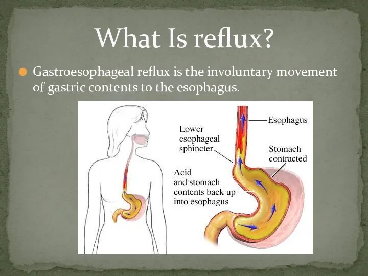 Gastroesophageal reflux is the involuntary movement of gastric contents to the esophagus. What Is reflux?
