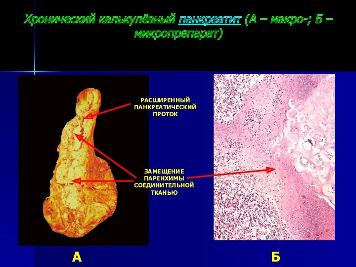 Хронический калькулёзный панкреатит (А – макро-; Б – микропрепарат) А