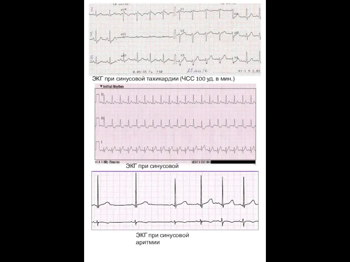ЭКГ при синусовой тахикардии (ЧСС 100 уд. в мин.) ЭКГ при синусовой тахикардии