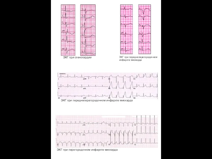 ЭКГ при стенокардии ЭКГ при переднеперегородочном инфаркте миокарда ЭКГ при переднеперегородочном инфаркте миокарда