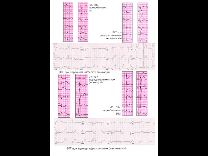 ЭКГ при переднебоковом ИМ ЭКГ при распространенном переднем ИМ ЭКГ при переднем инфаркте