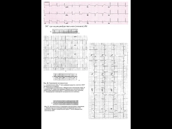 ЭКГ при заднедиафрагмальном (нижнем) ИМ