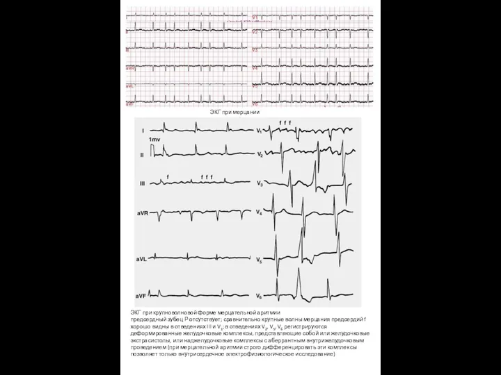ЭКГ при мерцании предсердий ЭКГ при крупноволновой форме мерцательной аритмии предсердный зубец Р